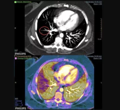 Example of spectral, or dual-energy CT, confirming a pulmonary embolism (PE). Image courtesy of Philips Healthcare