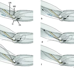 New IR procedure for cubital tunnel syndrome