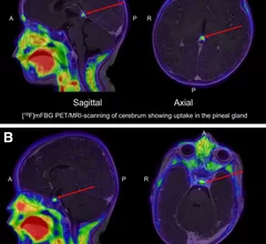 New PET technique improves imaging of pediatric neuroblastoma.