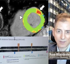 Ron Blankstein, MD, FACC, FASNC, MSCCT, FASPC, associate director, cardiovascular imaging program, director, cardiac computed tomography, Brigham and Women’s Hospital, and a professor of medicine and radiology, Harvard Medical School, explains a few of the recent advancements in cardiac MRI, nuclear imaging and computed tomography.