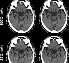 Deep learning denoising produces quality trauma head CT images at 25% of the radiation dose