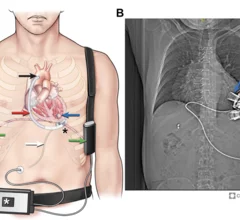 The American Society of Echocardiography (ASE) has shared new recommendations for performing medical imaging exams on heart failure patients with surgically implanted left ventricular assist devices (LVADs) and temporary mechanical circulatory support (TMCS) devices. The guideline, published in full in the Journal of the American Society of Echocardiography, represents ASE’s first update on the topic since 2015.[1] 