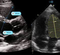 The iCardio.ai EchoMeasure AI software to automate measurements for cardiac echo imaging. It was FDA cleared in October 2024.