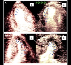 Ultrafast/high frame rate myocardial contrast echocardiography 