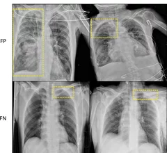 AI system detects pneumothorax on chest x-rays