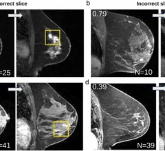 AI model spots missed breast cancers on MRI