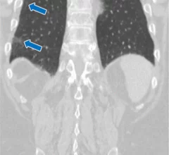 Incidental interstitial lung abnormalities largely underreported