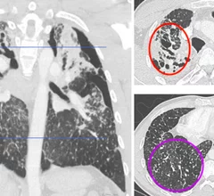 Silicosis on CT