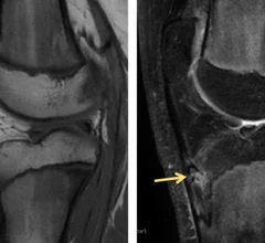 MRI of knee with Osgood-Schlatter Disease