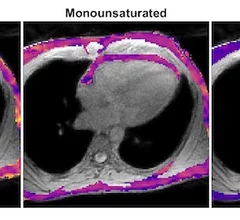 MRI technique analyzes composition of fat surrounding heart.