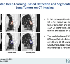 DL model identifies and segments lung tumors on CT scans.