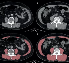 Obesity can improve lung cancer outcomes, but only if skeletal muscle quality is maintained