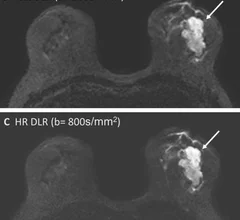 Deep learning reconstruction improves breast MRI quality