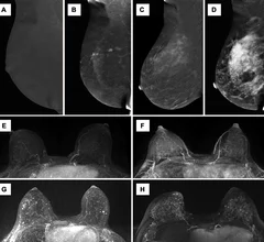 BPE on contrast-enhanced mammograms.