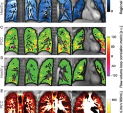 Children show signs of post-COVID lung damage on MRI.