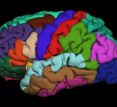 FreeSurfer, the brain modeling program used to measure cortical thickness and white matter volume.