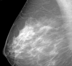 Women with dense breasts and benign breast disease have increased risks of developing #breastcancer