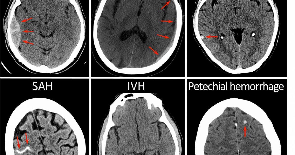 CT brain image gallery - SAH