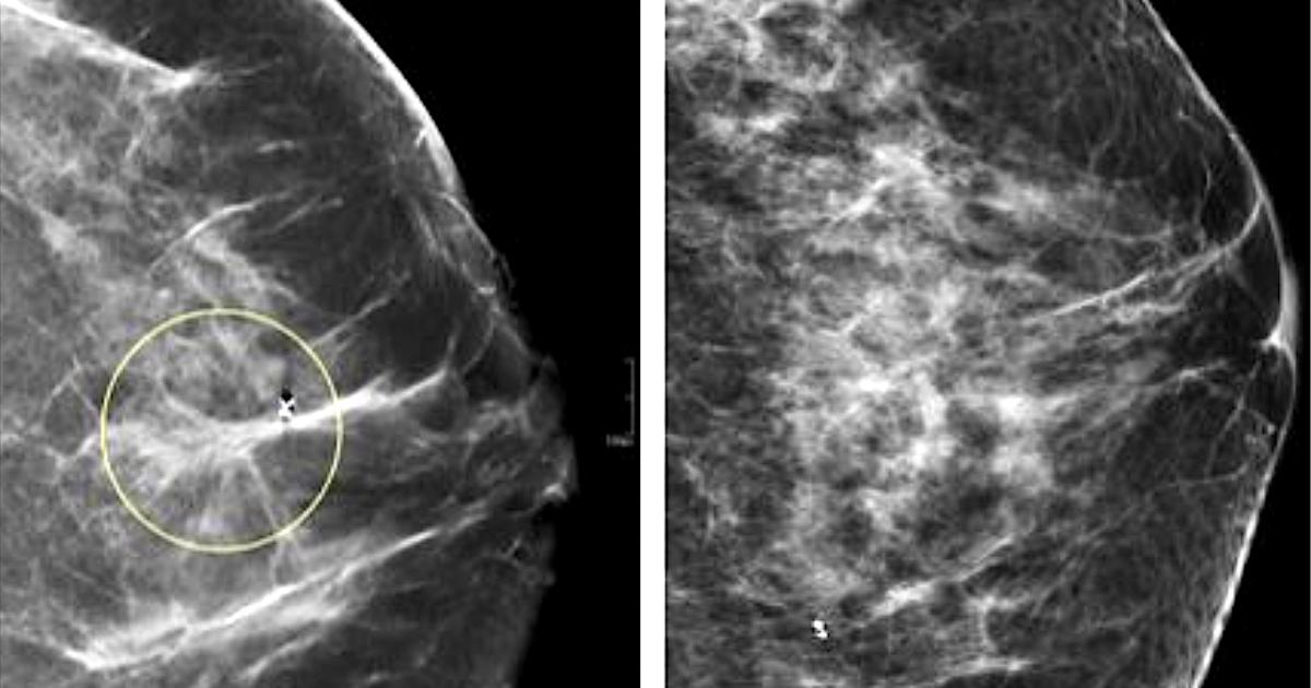 Die Leistung von Radiologen hat sich seit der Einführung der DBT für die Brustkrebsvorsorge verbessert