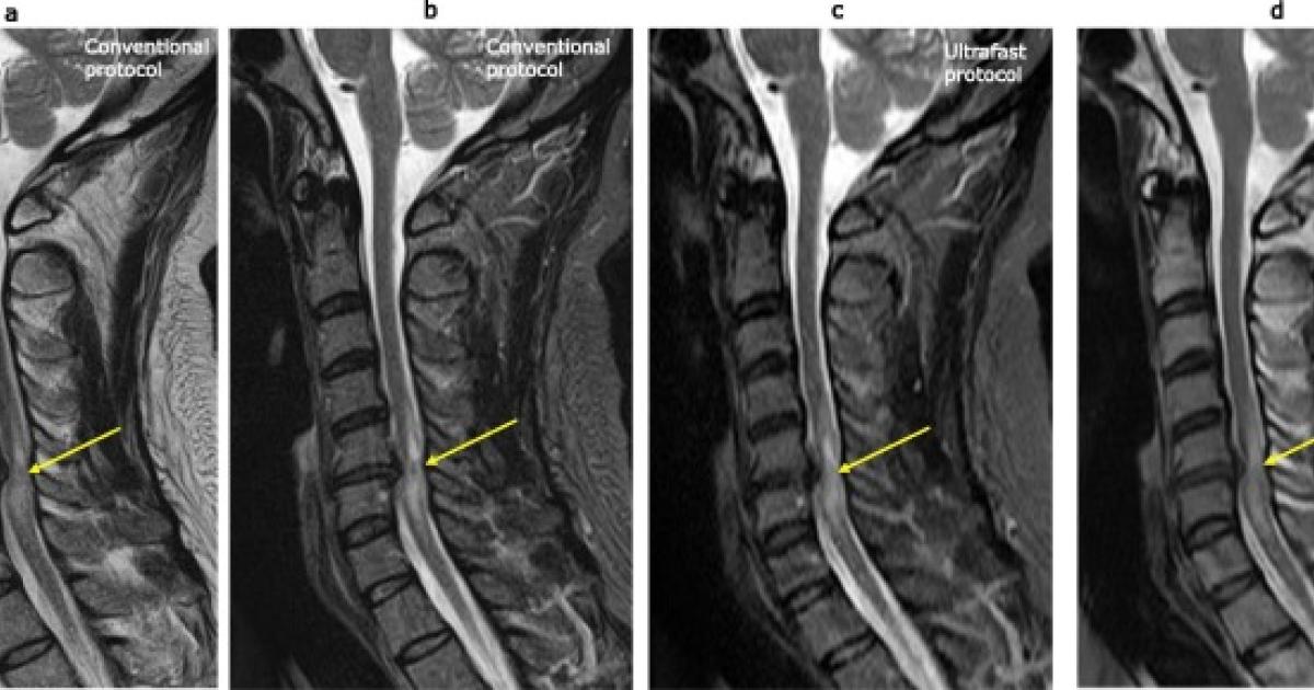 Imaging Of The Spine And Spinal Cord: An Overview Of, 58% OFF