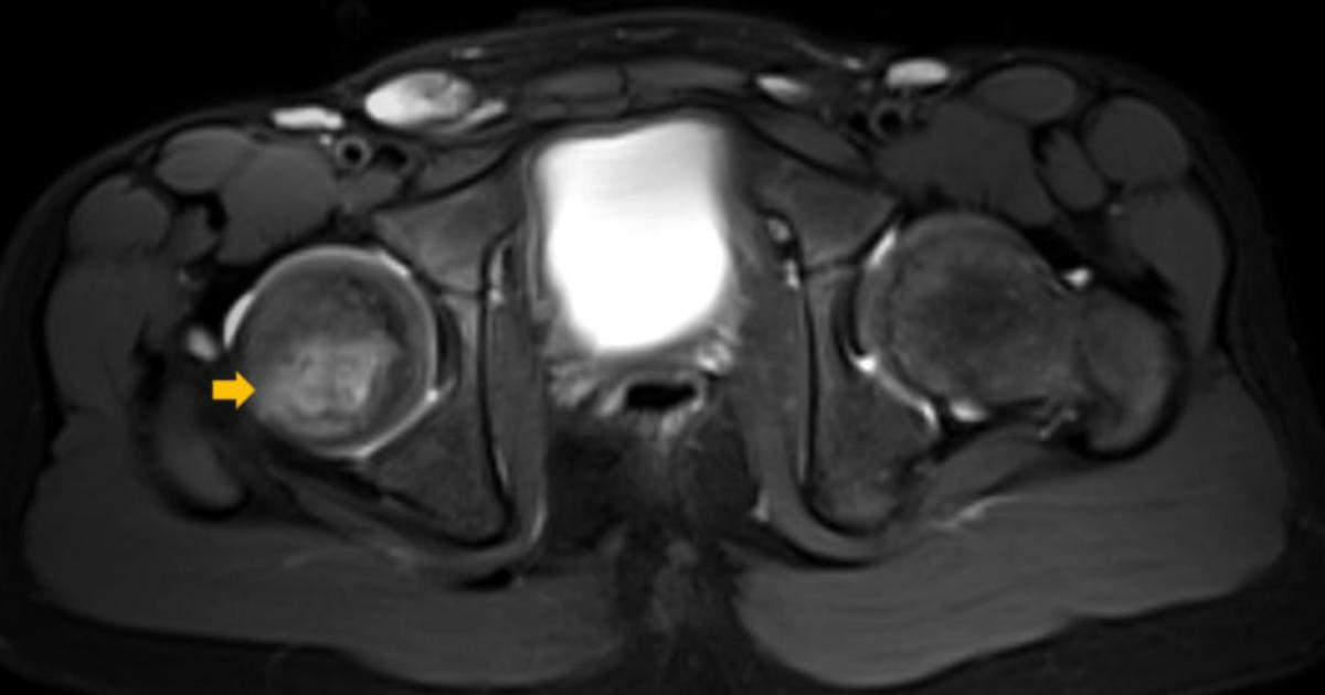 Diagnose einer Osteomyelitis mit verkürzten MRT-Protokollen ohne Kontrastmittel