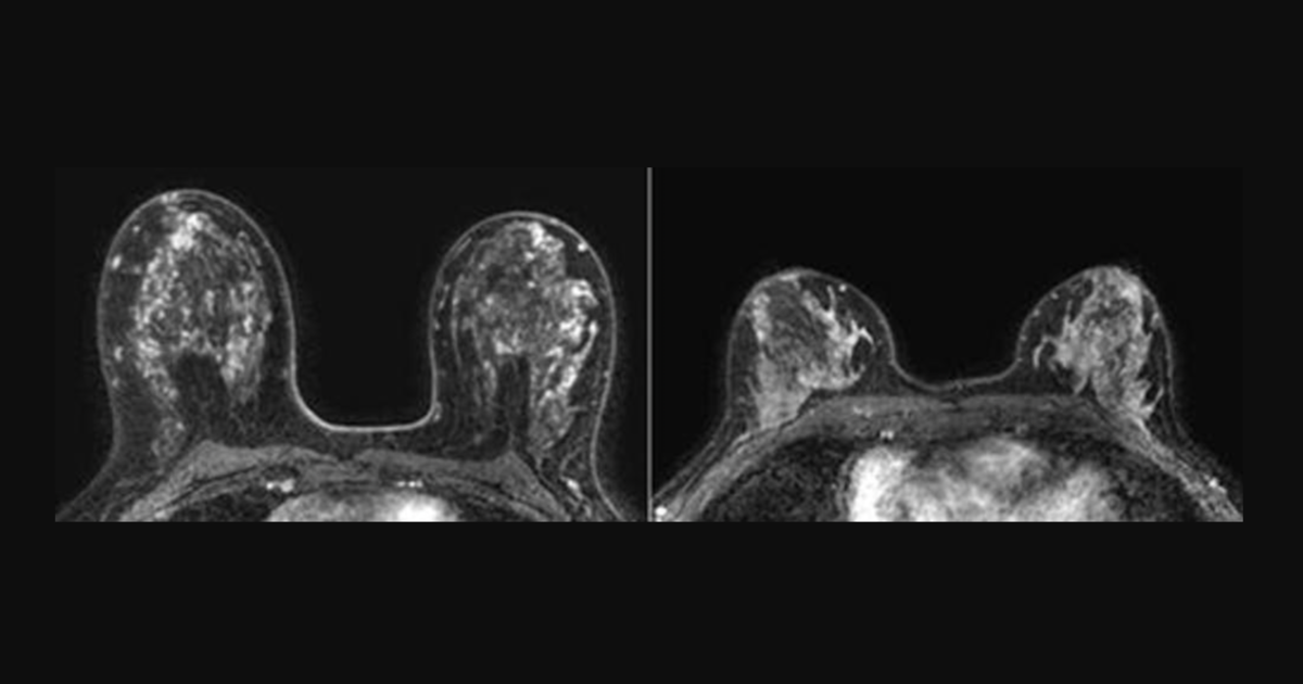 Odkrycie MRI wiąże się ze zwiększonym ryzykiem raka u kobiet z piersiami o dużej gęstości