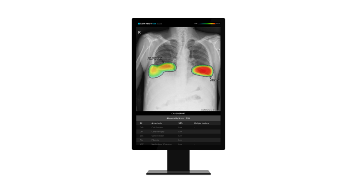 コラボレーションにより、胸部 X 線検査にトリアージ AI が導入され、迅速な緊急治療が可能になります