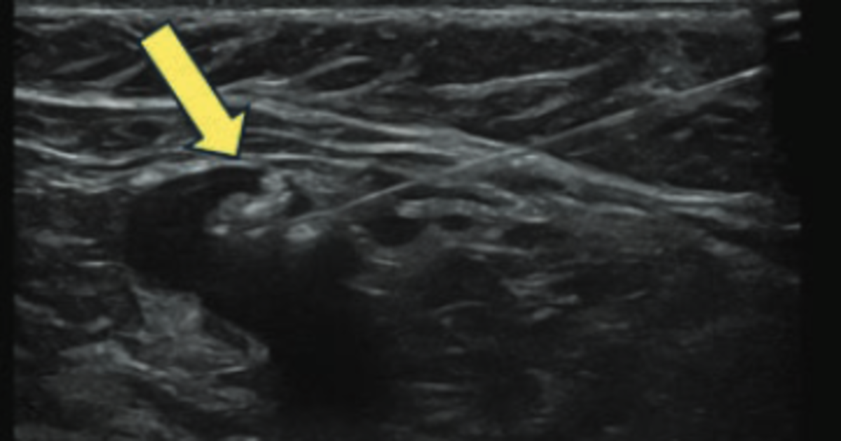 タトゥーインクはセンチネル腋窩リンパ節の位置を特定するための有望な選択肢