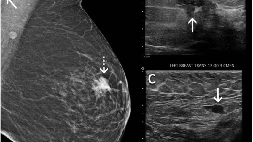 PHOTO GALLERY What does breast cancer look like on mammography