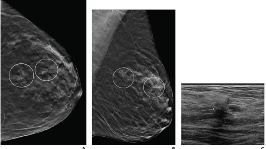 Plasmacytoma of the breast. Left mammogram shows (A) a small well