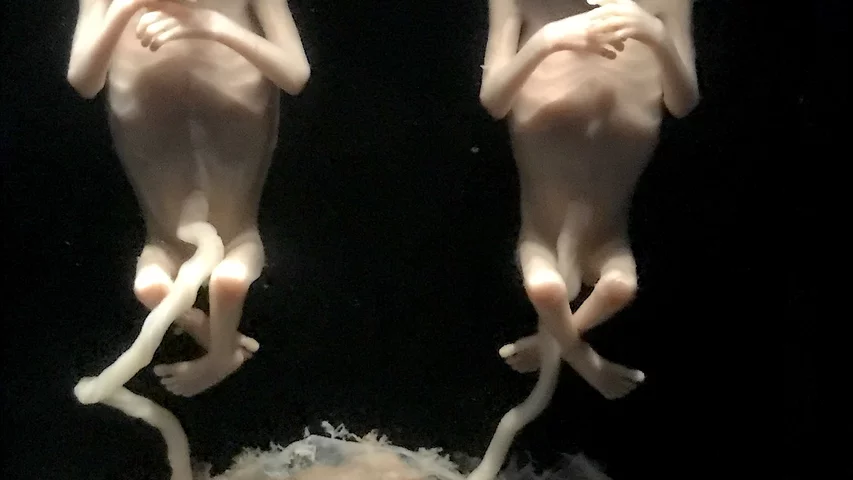 Preserved 13-week-old twin fetuses and placenta on display as part of a permanent exhibit on the stages of fetal development at the Chicago Museum of Science and Industry. These two fetuses developed when a single fertilized egg split, but both share the same genes and are identical twins. Link to virtual tour of the exhibit. This image helps show correlation with fetal medical imaging. Photo by Dave Fornell 
