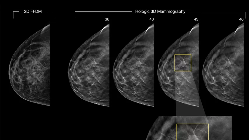 Mammogram Images: Normal and Abnormal