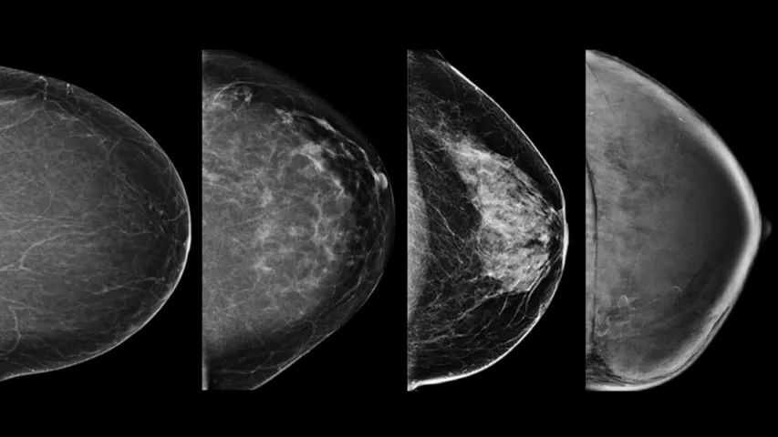 Mammogram Images: Normal and Abnormal