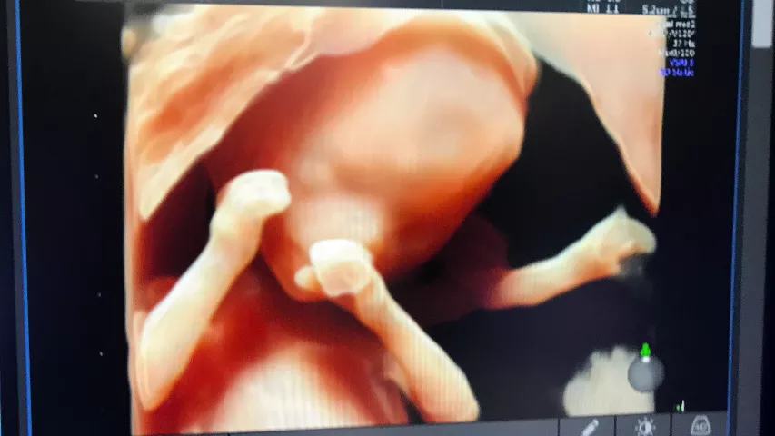 Example of 3D photo-realistic ultrasound technology at RSNA 2022. The simulated lighting source can be moved around to change the locations of the shadows. This makes for great portrait shots for the parents, but also allows physicians to better understand the relationship of anatomical structures if needed during fetal assessments. This is the HDlive rendering technology on the GE Voluson E10 system. Baby ultrasound images. Fetal imaging. Example of a baby ultrasound. Foetus ultrasound.