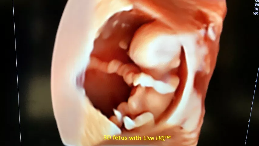 A 3D ultrasound fetal image showing the umbilical cord inside the amniotic sac. Image courtesy of Alpinion. Example of a baby ultrasound.