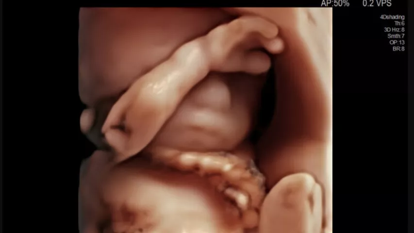 High definition 3D ultrasound of baby face. Image courtesy of Hitachi. Baby face on ultrasound on fetal imaging.