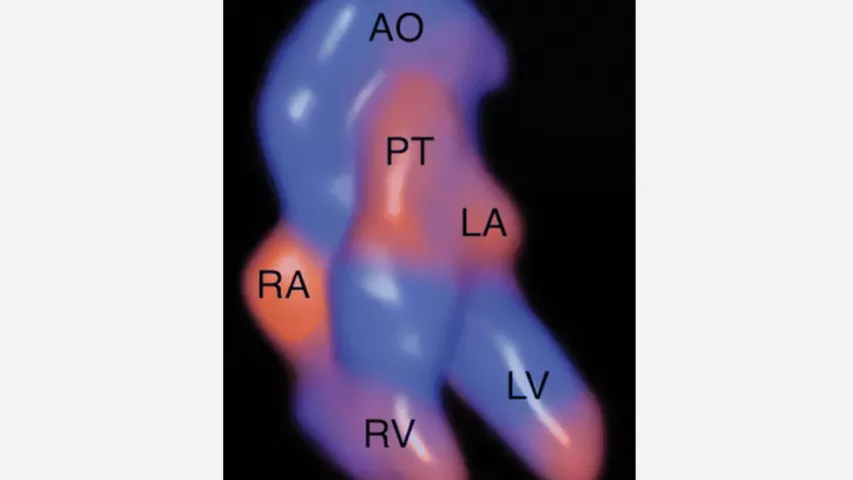 Four-dimensional “Glassbody” rendered image obtained in the Doppler cardiac spatio-temporal image correlation mode shows the fetal cardiac anatomy at 16 weeks gestation. Retrograde flow is in red, and antegrade flow is in blue. This type of view may help earlier diagnosis of congenital heart disease in fetal imaging. AO = aorta, LA = left atrium, LV = left ventricle, PT = pulmonary trunk, RA = right atrium, RV = right ventricle. Image courtesy of RSNA. Baby heart images, Fetal hart