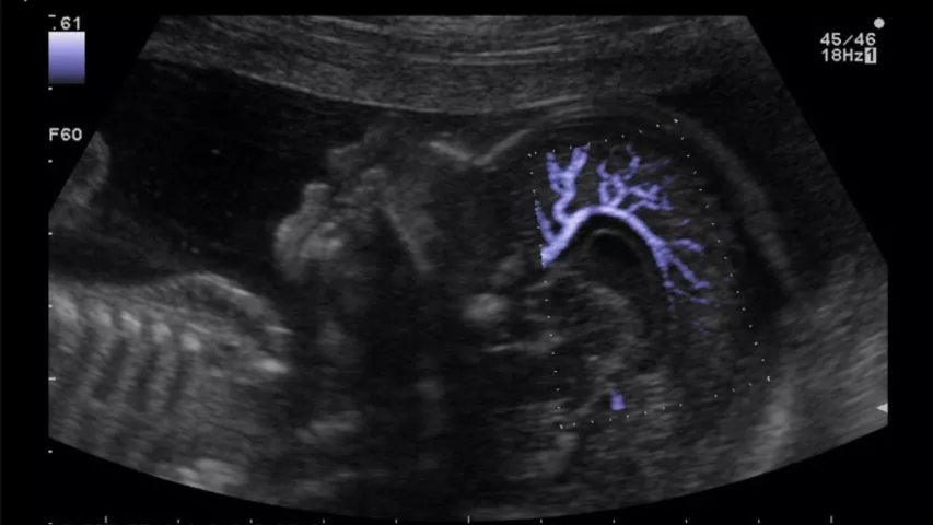 Third trimester fetal face and cerebral blood flow images with a Hitachi Prosound F37 ultrasound system. Ultrasound of pericallose artery in fetal brain with highly sensitive color mode (DFI). Image courtesy of Hitachi. Baby brain, baby ultrasound images.