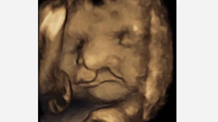 Example of a cleft lip detected on 3D fetal ultrasound. Image courtesy of RSNA. Example of a baby face ultrasound, fetal imaging.