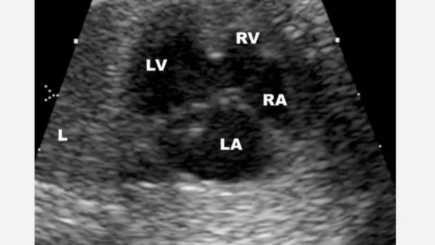 A congenital heart defect seen on a fetal ultrasound. The connection between the right and left ventricles is a ventricular septal defect (VSD), which can cause unoxygenated blood to be recirculated through the body. Image courtesy of RSNA. CHD VSD image. A VSD is also commonly called a "hole in the heart."