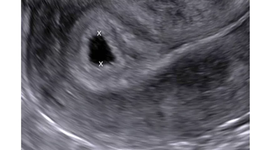 Early first-trimester ultrasound measurements to calculate the gestational age of the pregnancy prior to the embryo appearing in imaging. This is the average of orthogonal diameters of the gestational sac, measured from inner border to inner border. An intrauterine sac–like structure without a yolk sac or embryo, as seen in this example, is described as a probable intrauterine pregnancy. Follow-up ultrasound is performed at 14 days, at which time a live embryo should be visible. Images courtesy of RSNA.