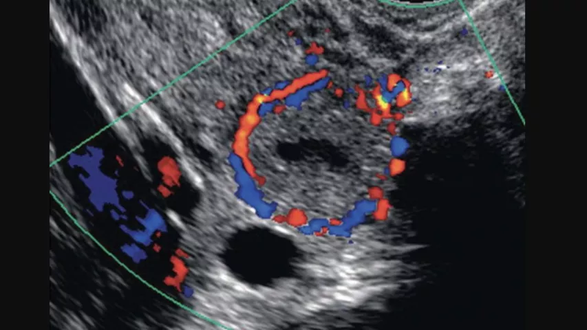 MRI findings in ruptured ovarian ectopic pregnancy: an unexplored avenue. -  Document - Gale Academic OneFile