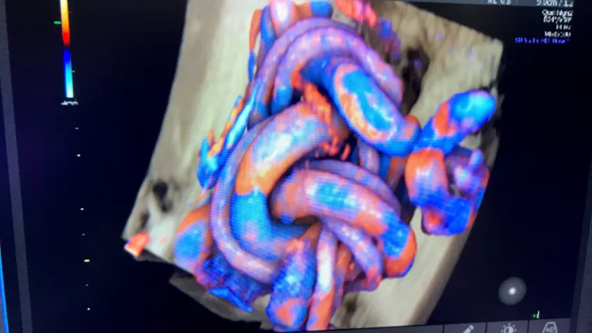 Umbilical cord tied into a knot from fetal movement seen on an 3D/4D ultrasound. The color coding shows the blood flow, which can help determine if the fetus is getting enough oxygen from the mother's blood supply. This is the HDlive rendering technology on the GE Voluson E10 system. Baby ultrasound photos. Fetal imaging. Example of a baby ultrasound.