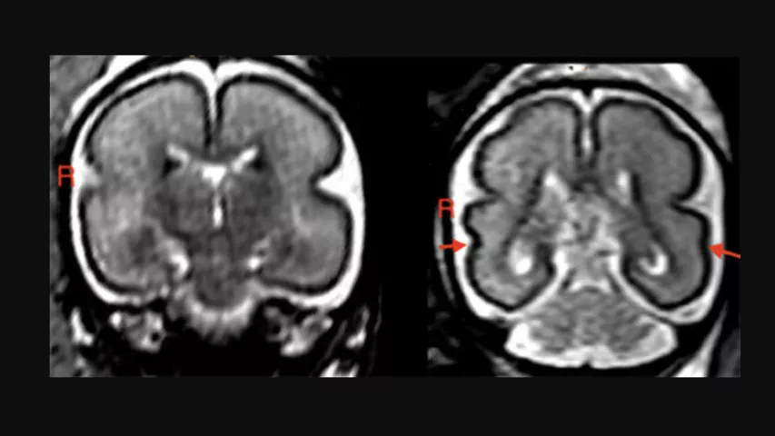 Alcohol consumption during pregnancy can change the unborn baby’s brain structure and delay brain development. Left: Fetal brain post-intrauterine alcohol exposure in fetus between 25 and 29 gestational weeks. Note the smooth cortex in frontoparietal and temporal lobes. Right: Brain of matched healthy control case in fetus between 25 and 28 gestational weeks. The superior temporal sulcus is already bilaterally formed (red arrows) and appears deeper on the right hemisphere than on the left. Image from RSNA