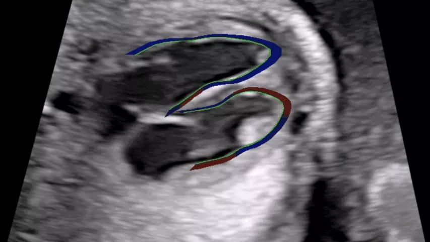 Example of a fetal heart contractility assessment ultrasound on the GE Voluson system. It divides fetal ventricles in 24 segments to simultaneously examine the size, shape and contractility of the fetal heart to help diagnose heart issues and congenital heart disease earlier in fetal development. Congenital heart defects affect 1 in 110 babies born around the world. Image from GE Healthcare. Fetal echo, echocardiogram exam. What is measured on baby ultrasounds, fetal imaging?