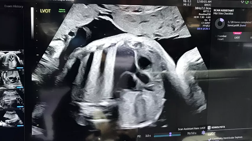 Assessment of the left ventricular outflow tract (LVOT) of the heart and aorta to look for congenital heart defect anomalies. A demo image from GE Healthcare at RSNA 2022. Fetal imaging. Example of a baby ultrasound.