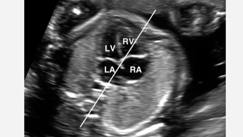 A standard four-chamber view of a fetal heart on ultrasound. The heart is examined to look for congenital heart disease (CHD), such as transposed vessels, connections between the chambers and defective heart valves. Image courtesy of RSNA