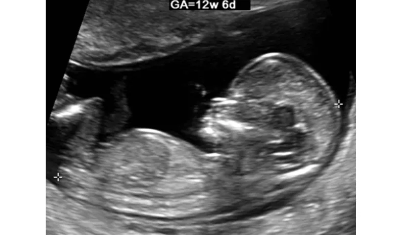 Ultrasound scan shows the fetus at the end of the first trimester, by which time the fetus has a recognizable human appearance. The maximal length in the craniocaudal direction is measured in a straight line between the calipers to make a crown-rump length (CRL) measurement. This is highly accurate for pregnancy dating in the first trimester, but other measures are used to assess gentational age later during the pregnancy. Images courtesy of RSNA. Baby ultrasound picture.