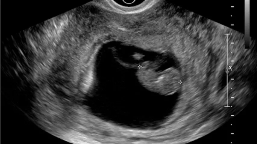 Transvaginal ultrasound of a fetus in early development during the first trimester. Baby ultrasound image courtesy of RSNA. Foetus ultrasound.