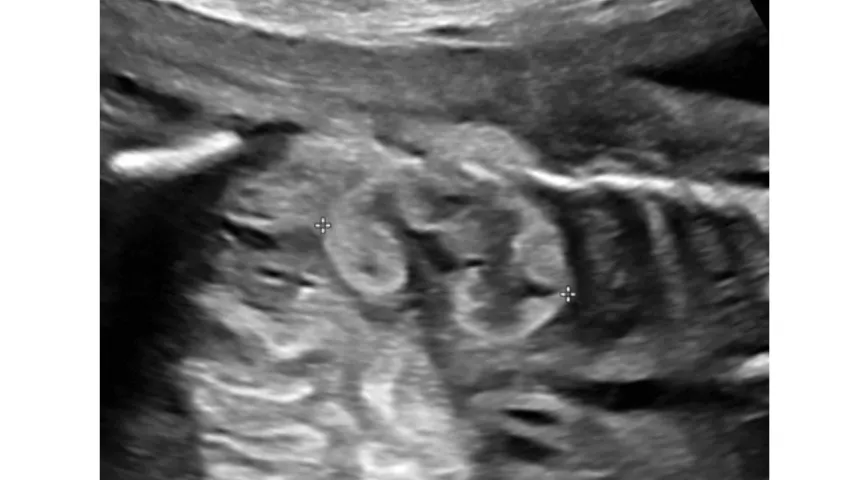 Ultrasound measurement of kidney length in a 23 week-old fetus. Renal measurements are one of several fetal anatomic structures that demonstrate consistent growth throughout the latter half of gestation, and measurements of these structures reliably correlate with gestational age (GA). This can be important in the second trimester and beyond as a more accurate measure of GA than body length. Image courtesy of RSNA. Baby, fetal clinical ultrasound images. What is measured on baby ultrasounds?
